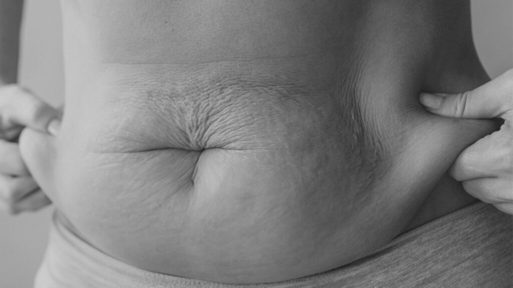 Kryolipolyse: Fettzellen eiskalt erwischt